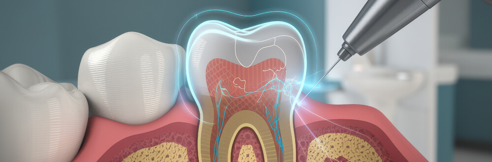 レーザー治療｜茨城県桜川市「土井歯科クリニック」